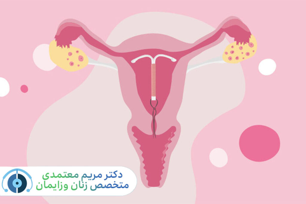 IUD چیست؟