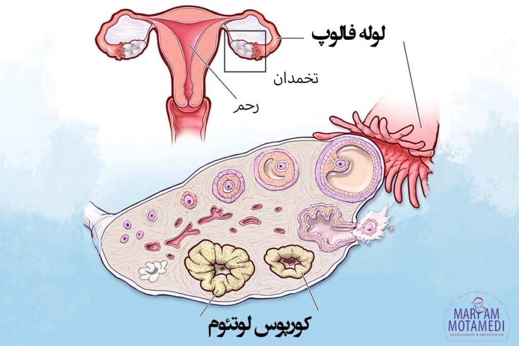 کیست کورپوس لوتئوم