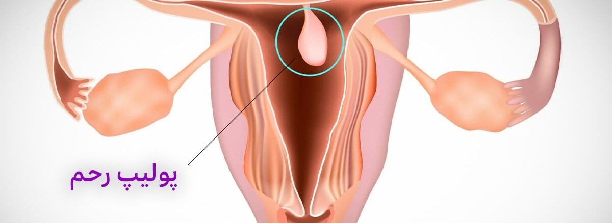 پولیپ رحمی