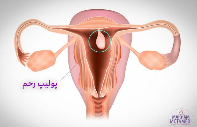 پولیپ رحمی